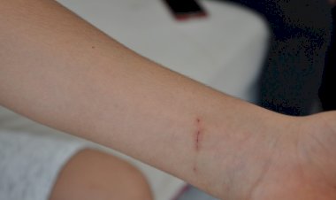 Evinin önünde köpek ısırdı